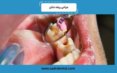 جراحی ریشه دندان چیست؟