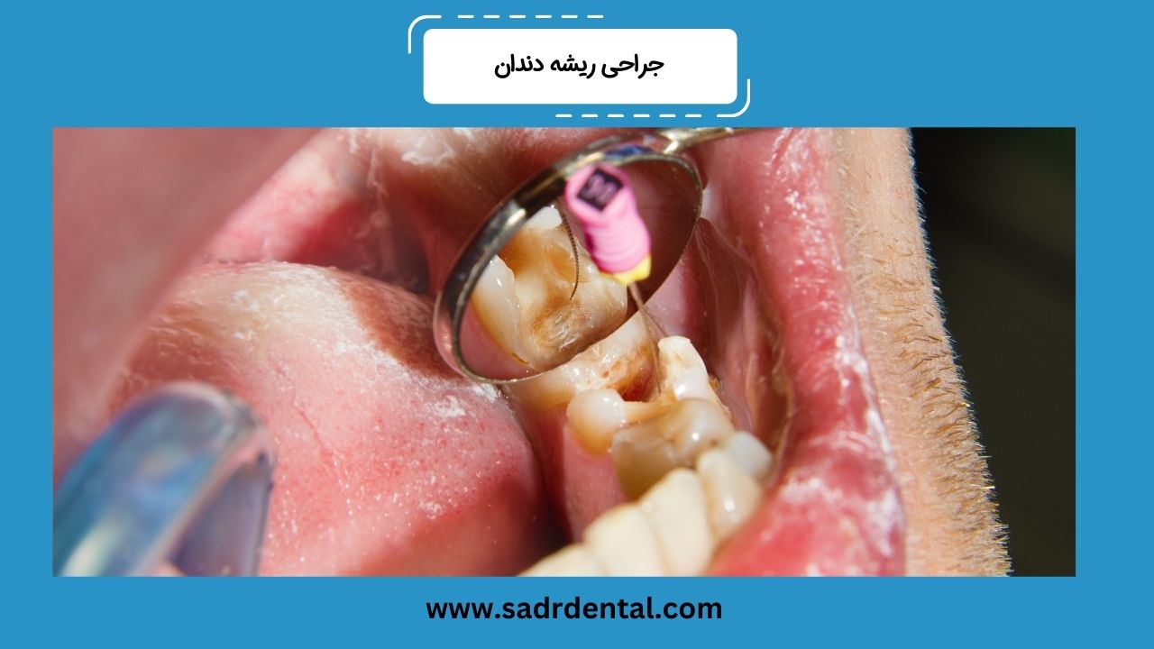 جراحی ریشه دندان