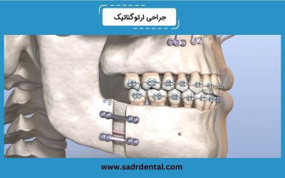 جراحی اصلاح فک یا جراحی ارتوگناتیک چیست؟ دلایل و نحوه انجام