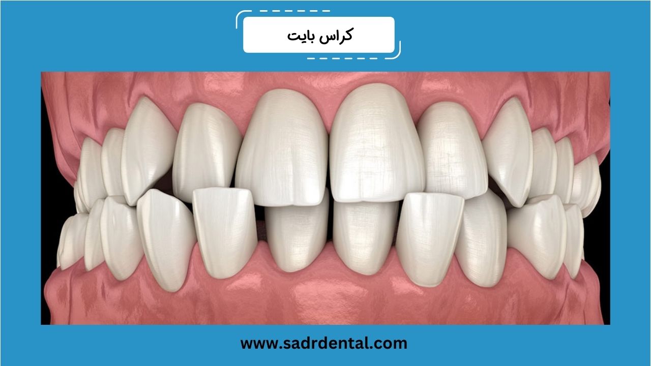 کراس بایت دندان