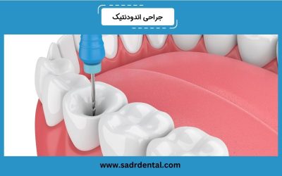درباره جراحی اندودنتیک بیشتر بدانید