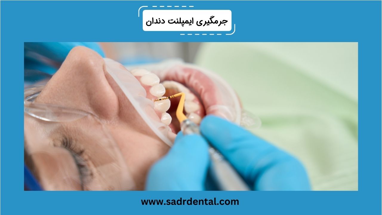 جرمگیری ایمپلنت دندان