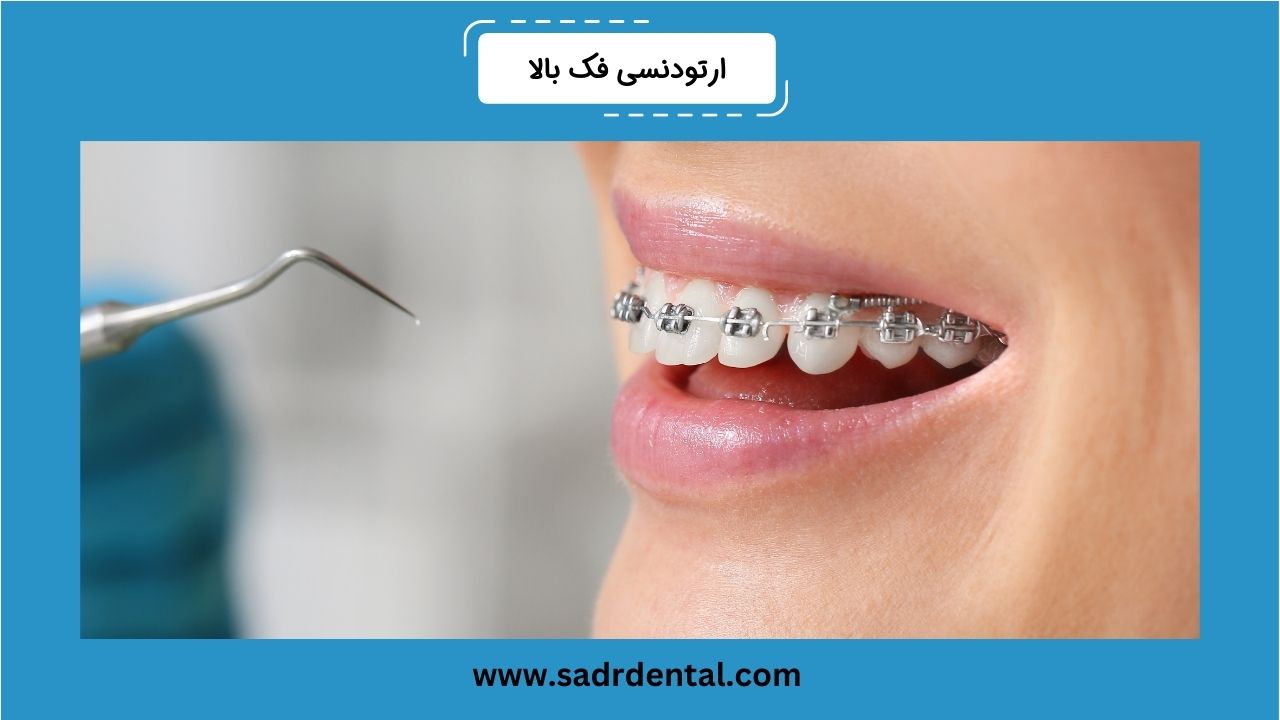 ارتودنسی فک بالا