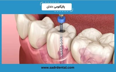 درباره پالپکتومی دندان بیشتر بدانید