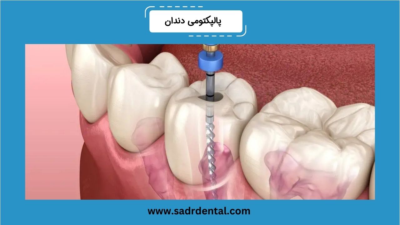 پالپکتومی دندان