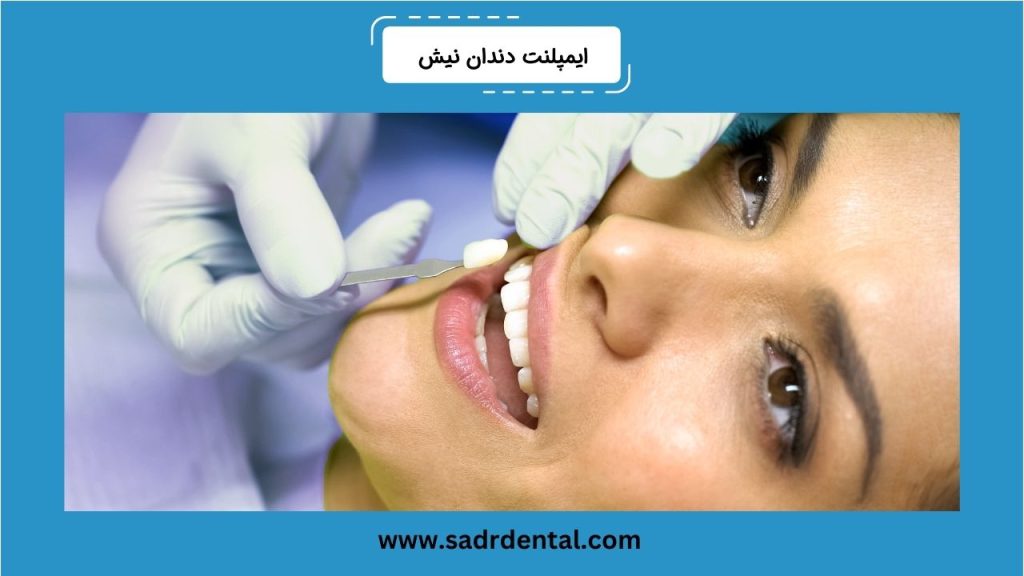 ایمپلنت دندان نیش