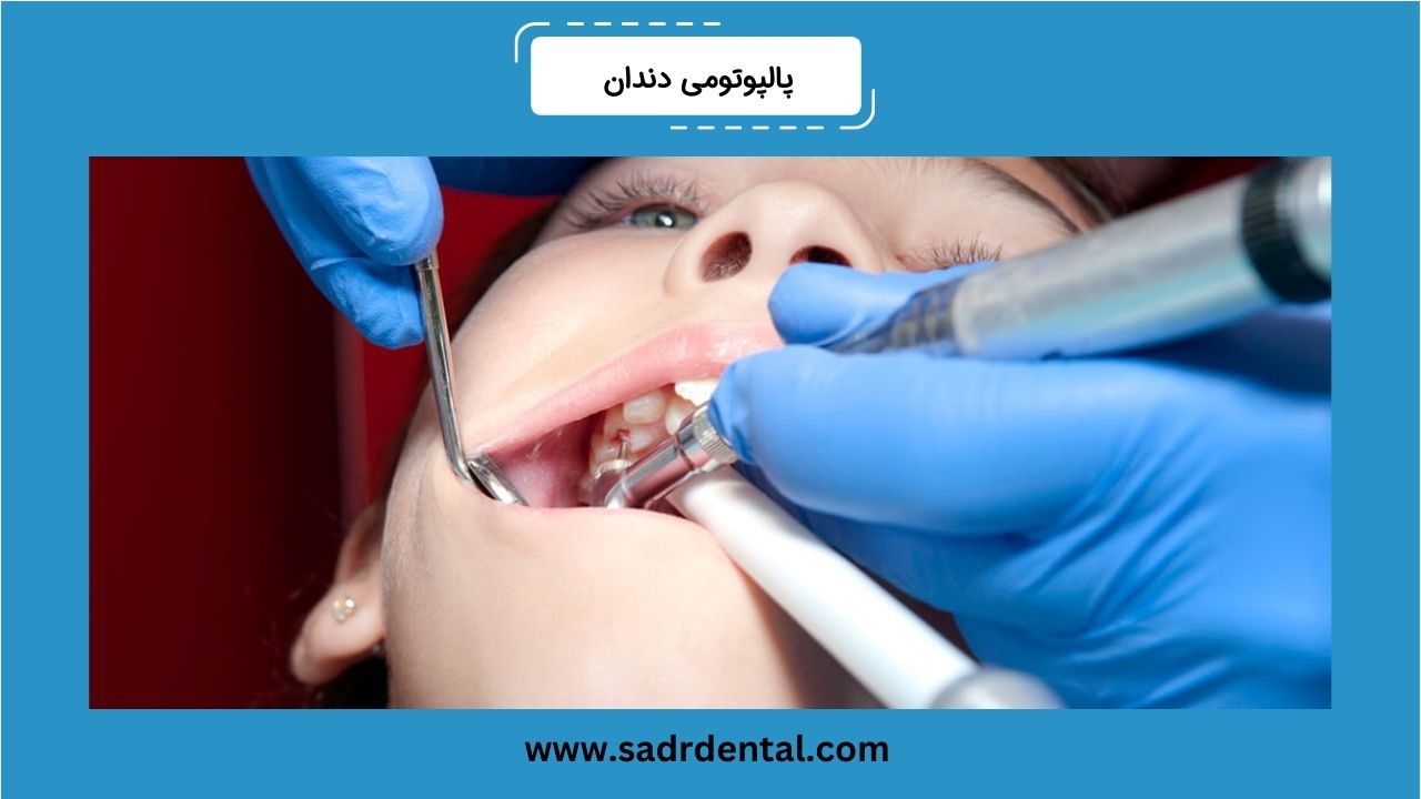 پالپوتومی دندان