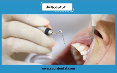 جراحی لثه یا جراحی پریودنتال چیست؟ دلایل، نحوه انجام و مراقبتها