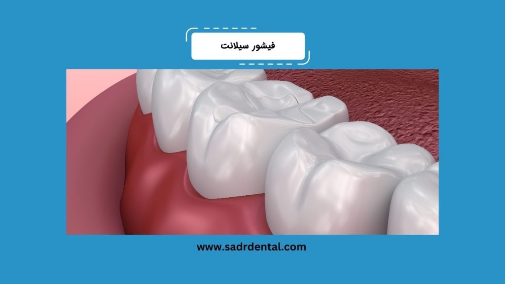 فیشور سیلانت