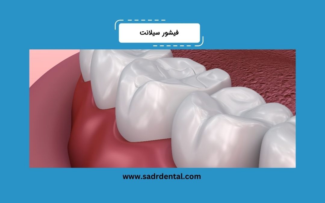 فیشور سیلانت چیست؟ نحوه انجام، مزایا و هزینه