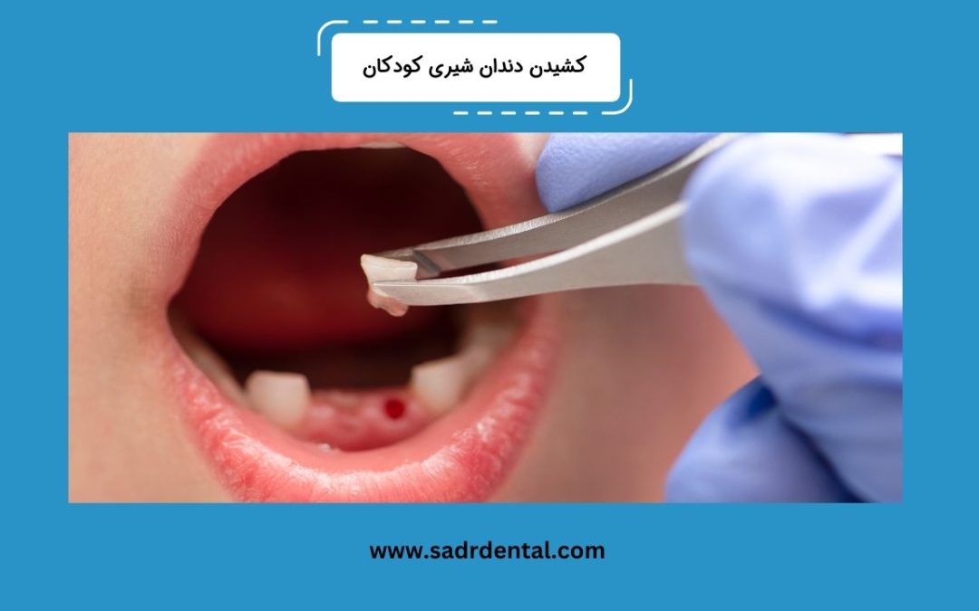 درباره کشیدن دندان شیری کودکان بیشتر بدانید