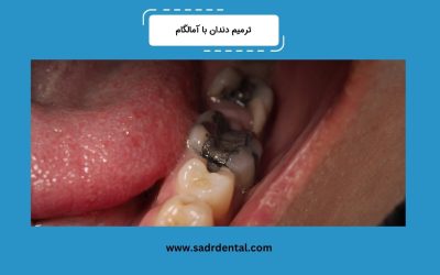 ترمیم آمالگام چیست؟ مزایا، معایب و مراحل