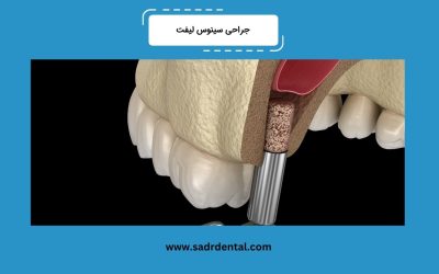 جراحی سینوس لیفت چیست؟ انواع، مراقبتهای لازم و قیمت