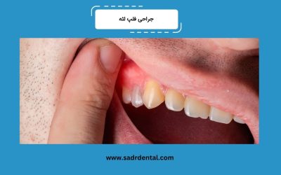 جراحی فلپ لثه چیست؟ مزایا، عوارض و مراقبتها